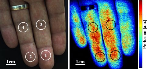 Perfusion map of fingers.